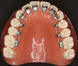 歯並びを改善する矯正治療